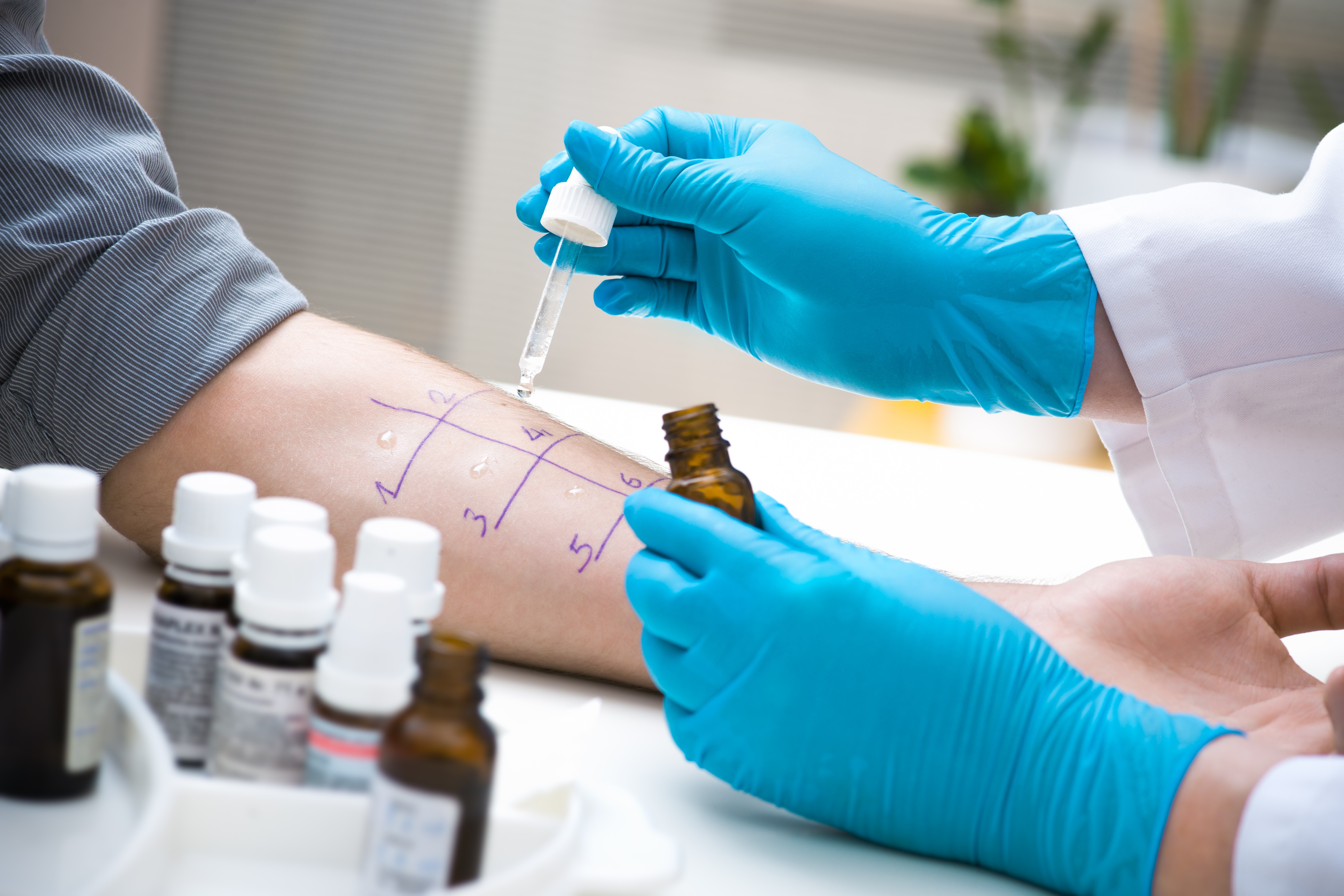 Testy na alergię - wskazania i rodzaje